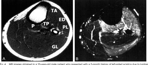 neurogenic foot drop images